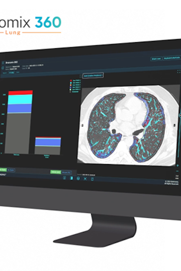 Boehringer backs Brainomix AI software for lung fibrosis