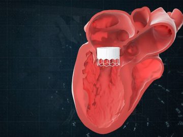 Materialise Expands Cardiovascular Capabilities With AI Software