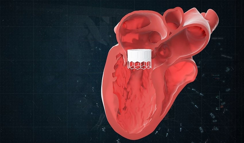 Materialise Expands Cardiovascular Capabilities With AI Software